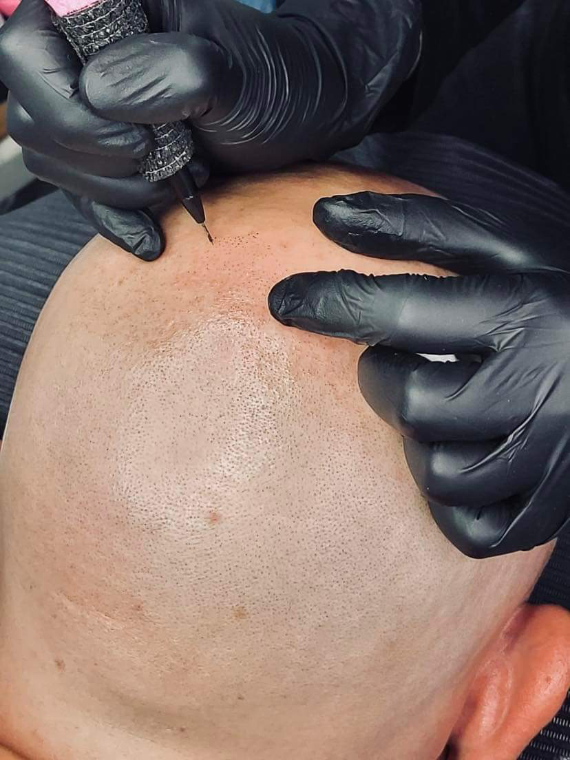 This is Scalp Micropigmentation (SMP) Also known as the HAIR TATTOO. S... |  TikTok